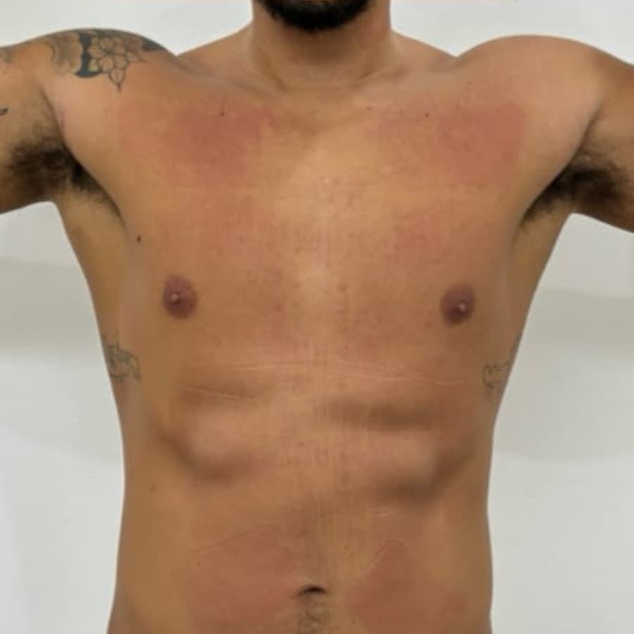 Muscle Building after treatment