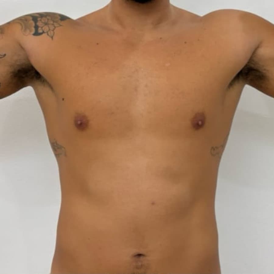 Muscle Building before treatment