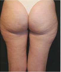 Cellulite after treatment