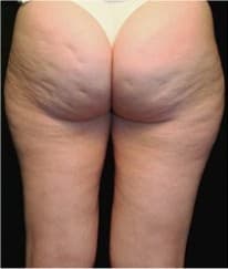 Cellulite before treatment