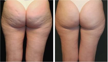 Cellulite before and after treatment
