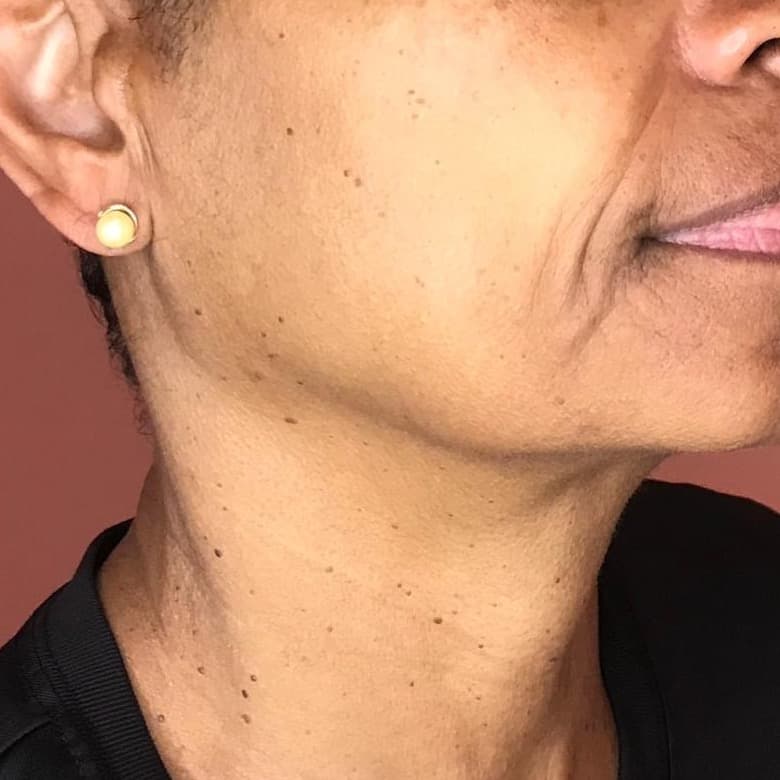 Neck & Décolletage Firming after treatment