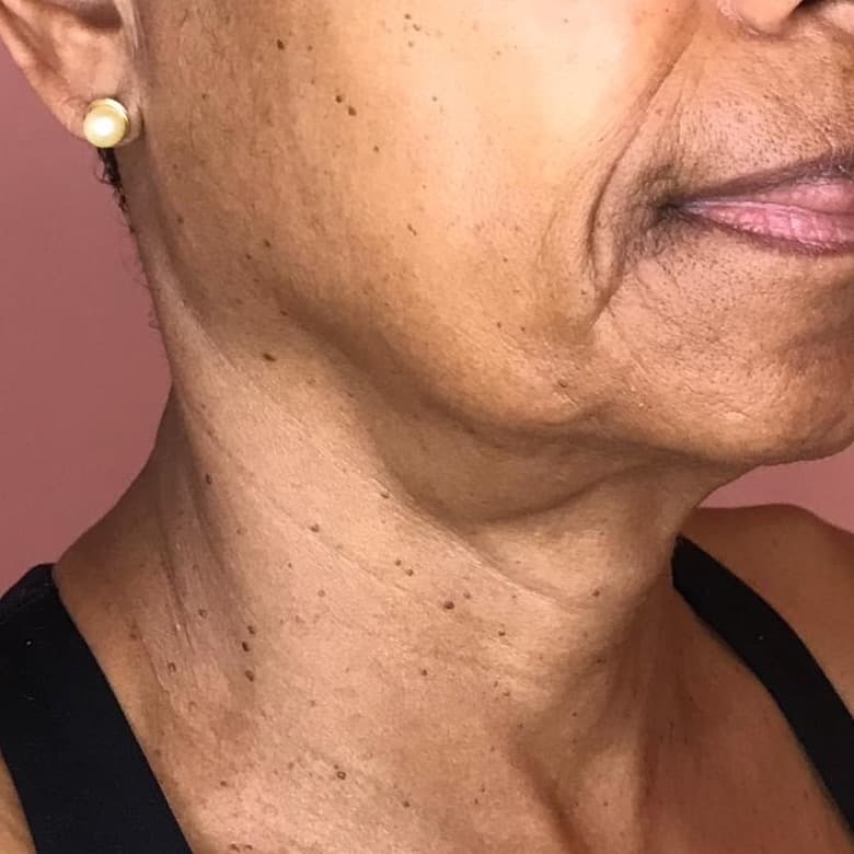 Neck & Décolletage Firming before treatment