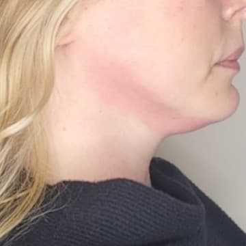 Profile Refinement after treatment