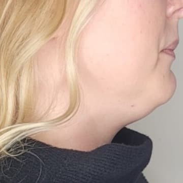 Profile Refinement before treatment