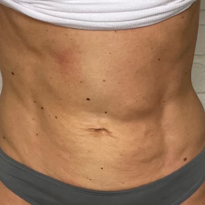 Skin Tightening after treatment