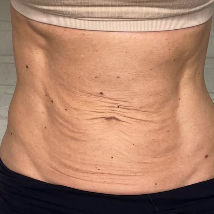 Skin Tightening before treatment
