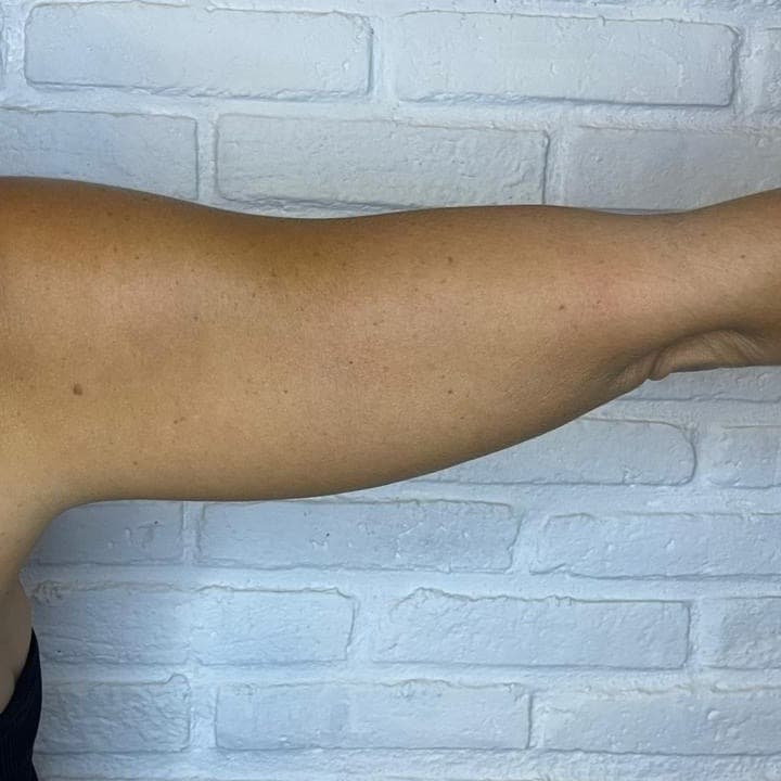 Slimming before treatment