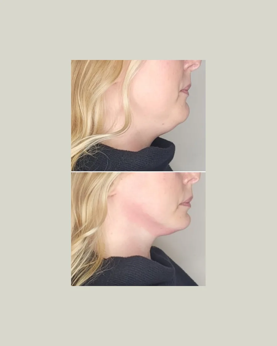 Double Chin Definition, 4 sessions: before-and-after result from Cryoskin Indonesia's own archive.
