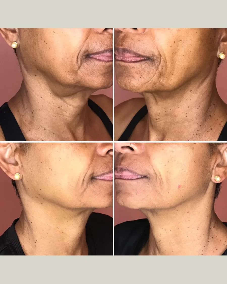 CryoFacelift, 4 sessions: before-and-after result from Cryoskin Indonesia's own archive.