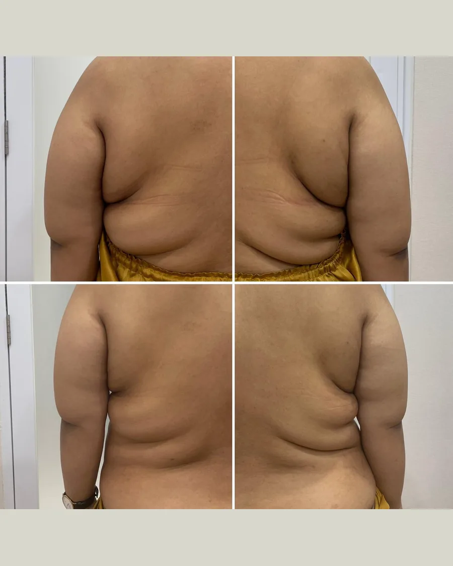 CryoSlimming Back, 1 session: before-and-after result from Cryoskin Indonesia's own archive.