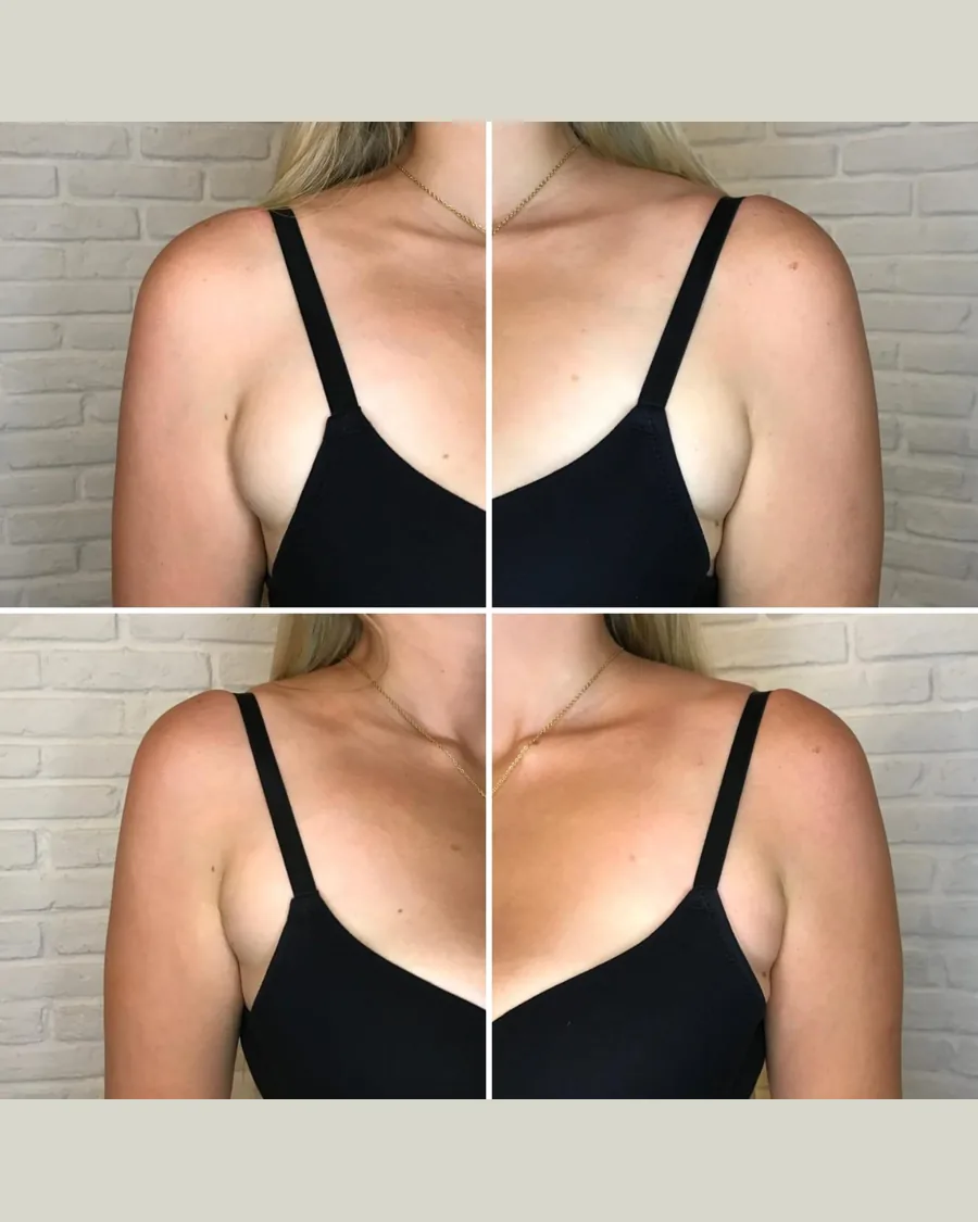 CryoSlimming Bra Line, 1 session: before-and-after result from Cryoskin Indonesia's own archive.