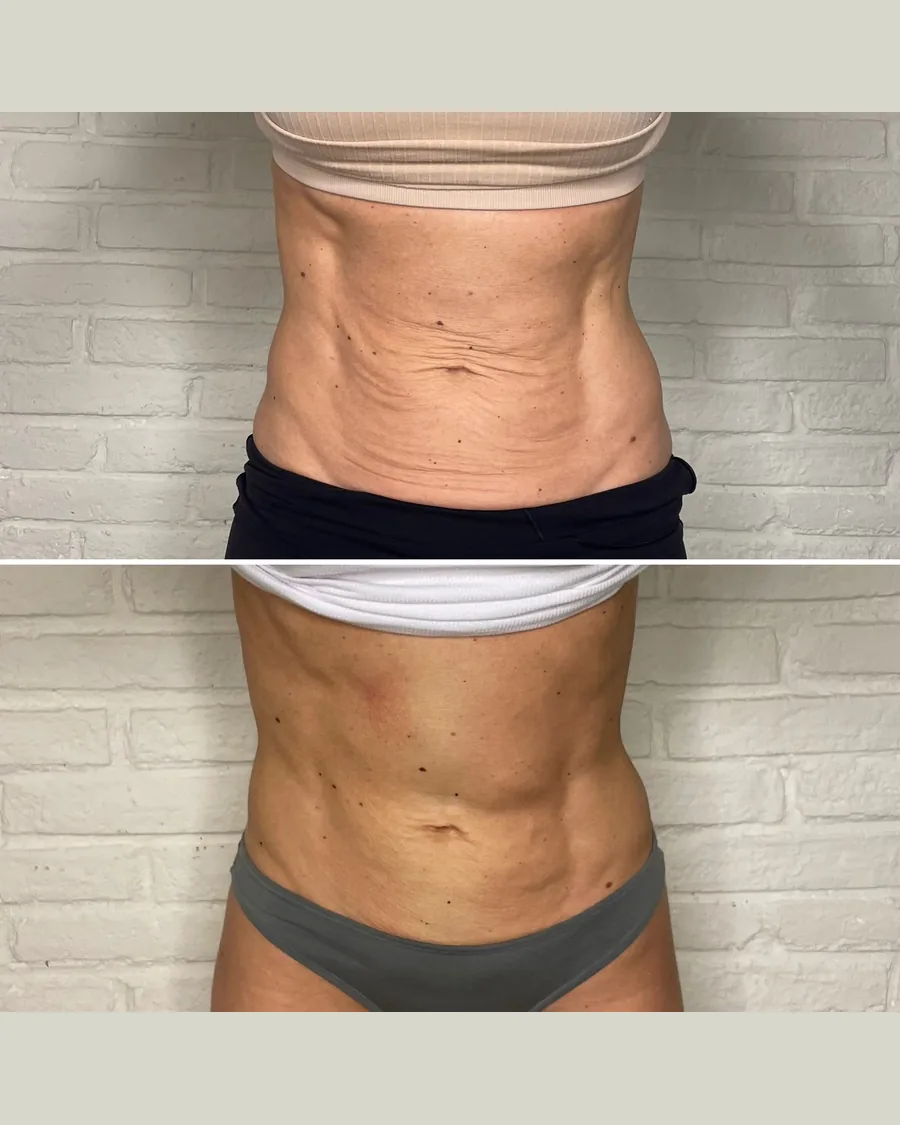 CryoToning Abdomen, 1 session: before-and-after result from Cryoskin Indonesia's own archive.