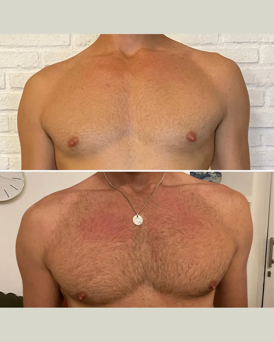NMS Muscle Growth, 4 sessions: before-and-after result from Cryoskin Indonesia's own archive.