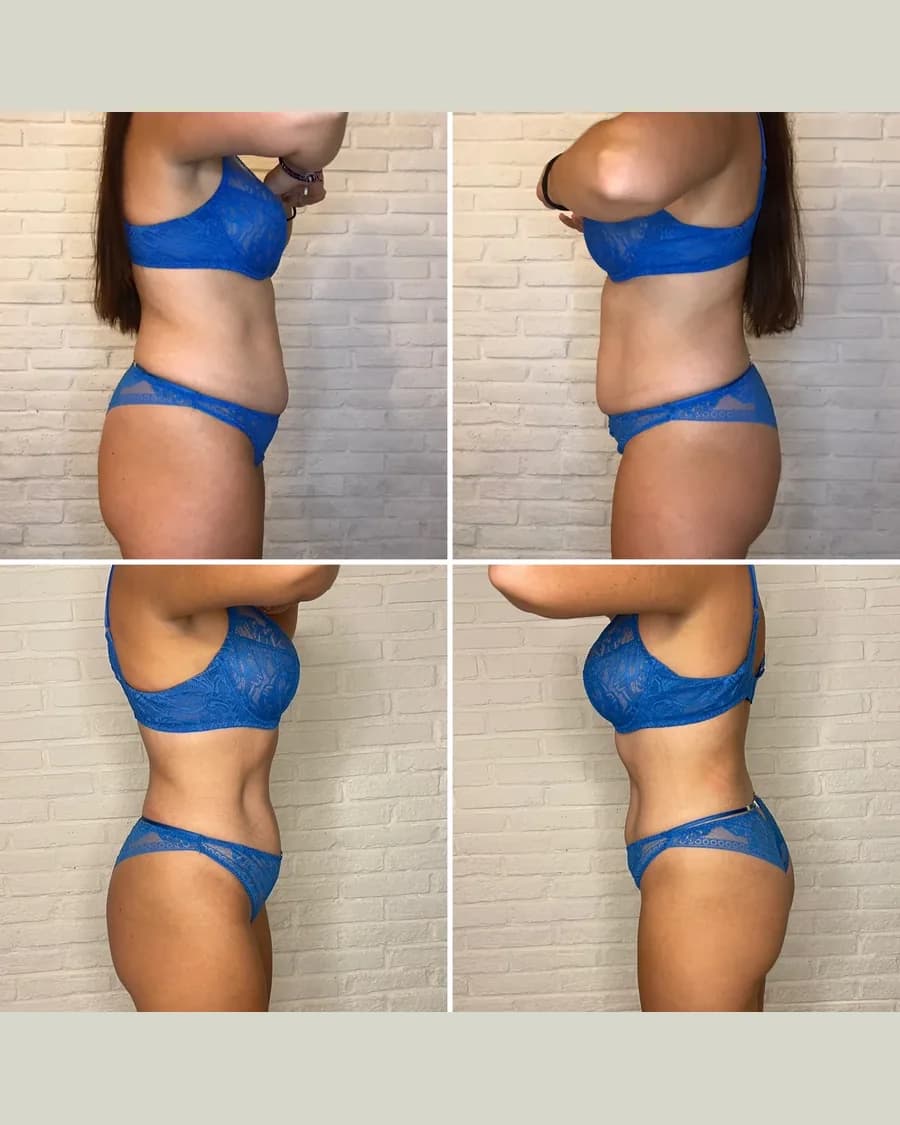 Slim & Sculpt, 3 sessions: before-and-after result from Cryoskin Indonesia's own archive.