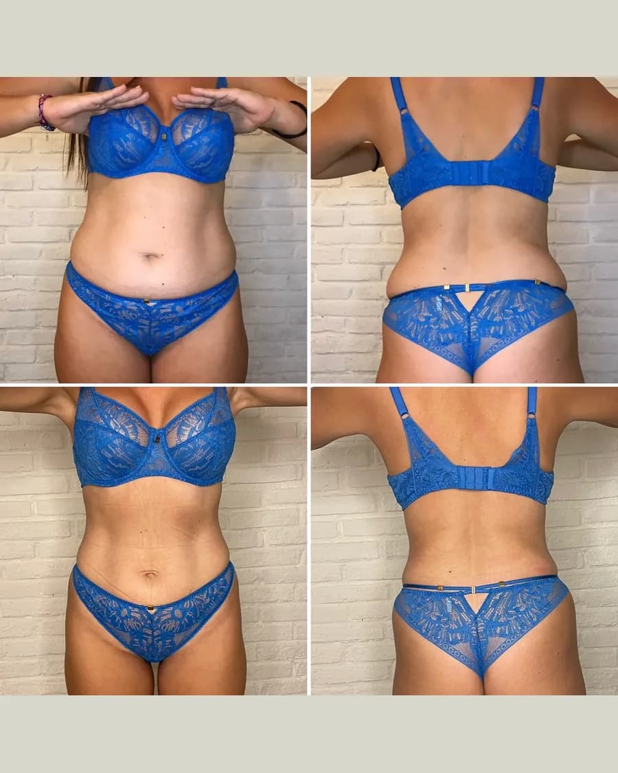 Slim & Sculpt, 3 sessions: before-and-after result from Cryoskin Indonesia's own archive.