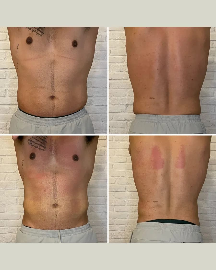 Slim & Sculpt, 1 session: before-and-after result from Cryoskin Indonesia's own archive.