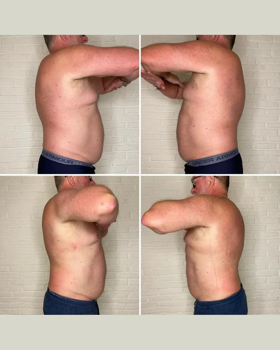 Slim & Sculpt, 1 session: before-and-after result from Cryoskin Indonesia's own archive.