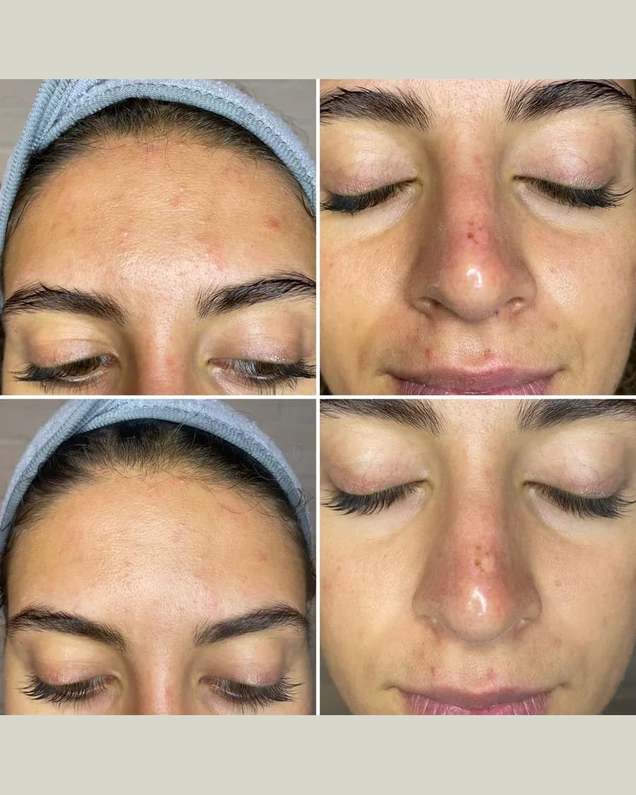 Ultra Plasma, 1 session: before-and-after result from Cryoskin Indonesia's own archive.